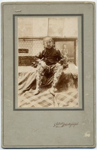 7140 1900s Formosa Old Medical Photo / Tree Man W Freak Show Native Boy Taiwan