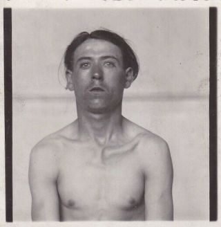 Silver Photograph 1930 Medical Unequal Clavicle Broken Collarbone Shirtless Man