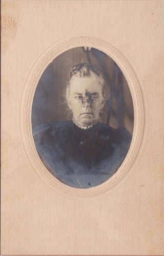 Cabinet Card Medical Photograph Woman’s Face 1900