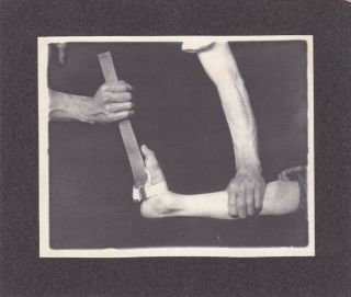 Vintage Silver Photo 1920 And Creepy Medical Leg In Traction