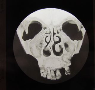 Glass Magic Lantern Slide A Human Skull No2 C1910 Autopsy Related ? An Xray ?