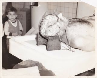 Large Vintage Silver Photograph 1950s Morgue Child Autopsy Scalped Post Mortem