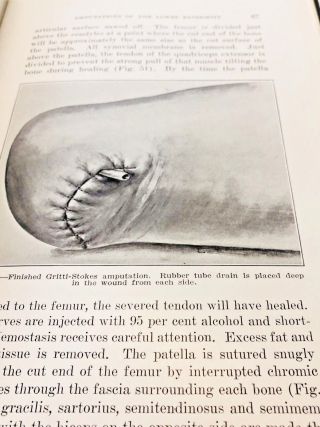 Modern Methods of Amputation by Thomas G.  Orr (1926) Medicine 3