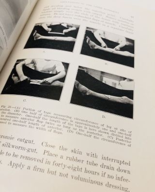 Modern Methods of Amputation by Thomas G.  Orr (1926) Medicine 4