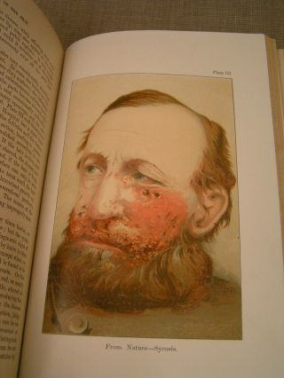 Diseases of the Skin 1892 John V.  Shoemaker Antique Medical Book w/Color Plates 7