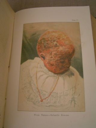 Diseases of the Skin 1892 John V.  Shoemaker Antique Medical Book w/Color Plates 8