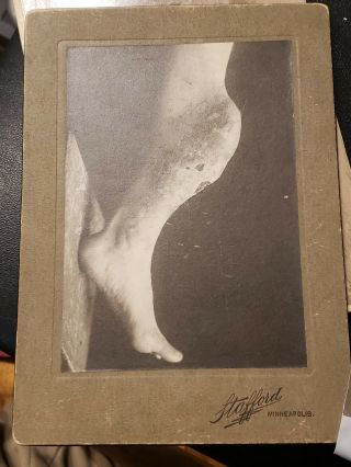 Rare Antique Medical Cdv Photo Gangrene Leg Civil War