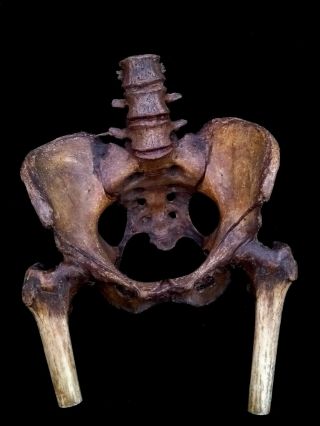 Very Rare Victorian,  Mummified Real Human Pelvis Bone & Ligament Preparation